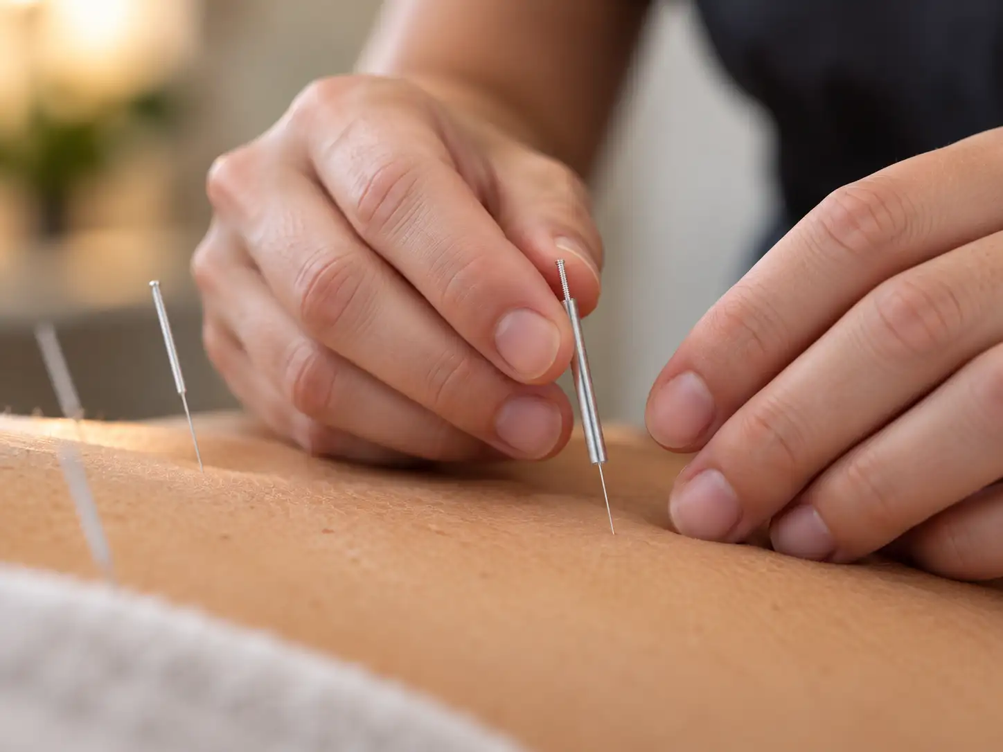 Close-up of a fine needle being positioned during treatment